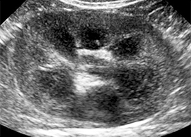 kidneyultrasound